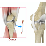 Bone Patellar Tendon Bone Allograft