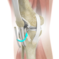 Bone Patellar Tendon Bone Autograft