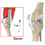 Hamstrings Allograft