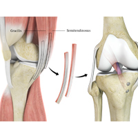 Hamstrings Autograft