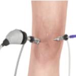 Knee Arthroscopy