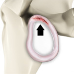 Labral Repair