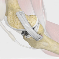 Medial Collateral Ligament (MCL) Reconstruction