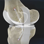 Posterior Cruciate Ligament Reconstruction