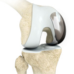 Unicondylar Knee Replacement