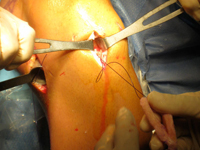 Meniscus Transplant