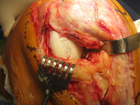 Osteochondral Allograft