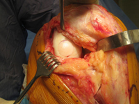 Osteochondral Allograft