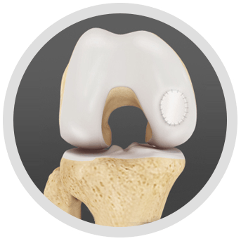 Cartilage Repair & Restoration